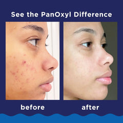 PanOxyl 10% Benzoyl Peroxide Acne Foaming Wash - 1oz: Paraben-Free, For Face & Body, Acne-Prone Skin